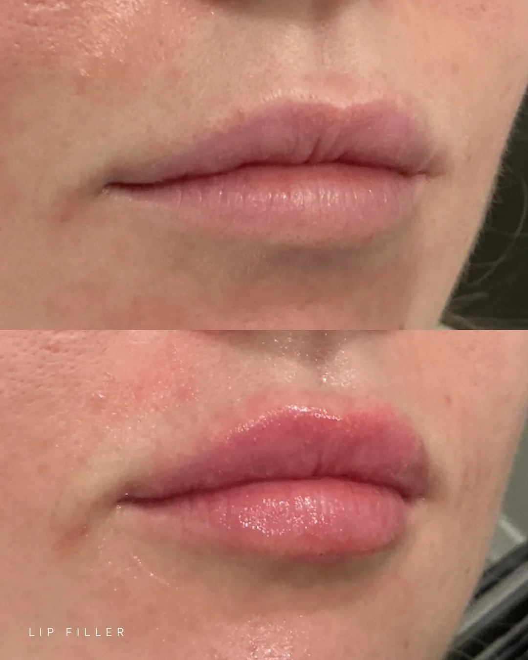 Beautiful from every angle 💋

Lip filler enhances shape, boosts hydration, smooths texture, and improves symmetry all while keeping results soft and natural.

No heaviness. Just balanced, refreshed lips from all sides!

Come see our lip experts at E