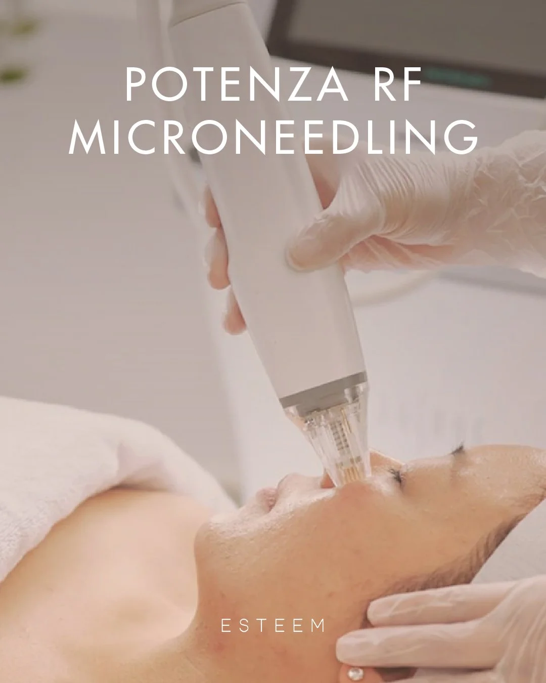 Not your average microneedling. ✨

Traditional microneedling works on the surface, but Potenza RF goes deeper. Book your personalized Potenza consultation at Esteem Medical Esthetics and let&rsquo;s map out your glow-up.