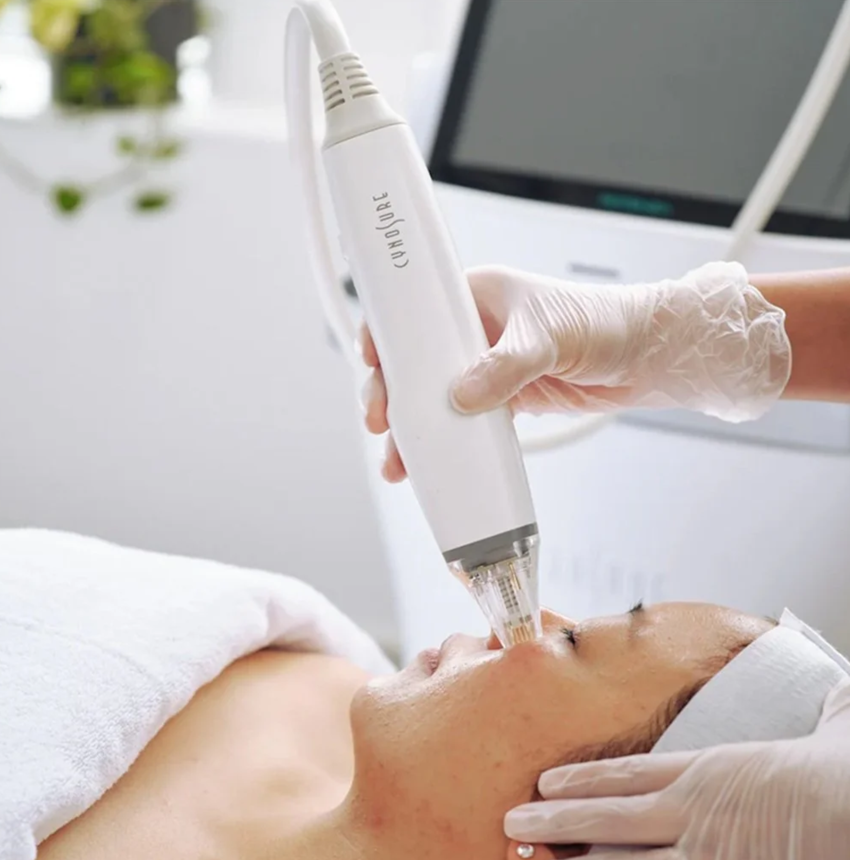 The Power of Potenza RF Microneedling