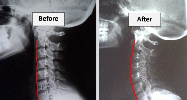 Actual pre and post. Patient treated approximately 12 weeks with our Dakota Traction device and exercise.