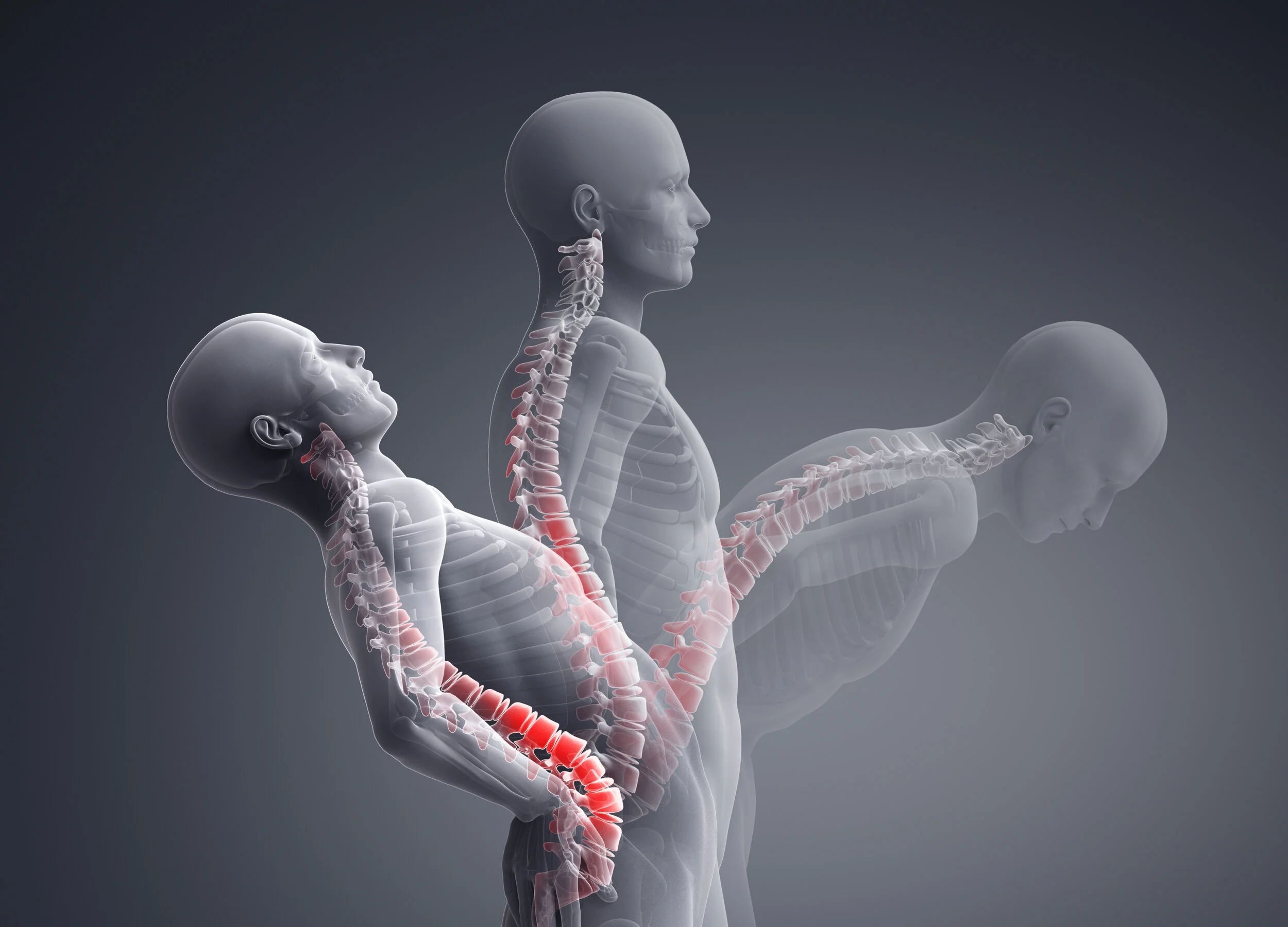 SIB# 404- Sagittal Alignment Correlated to Motion, Strength and Life