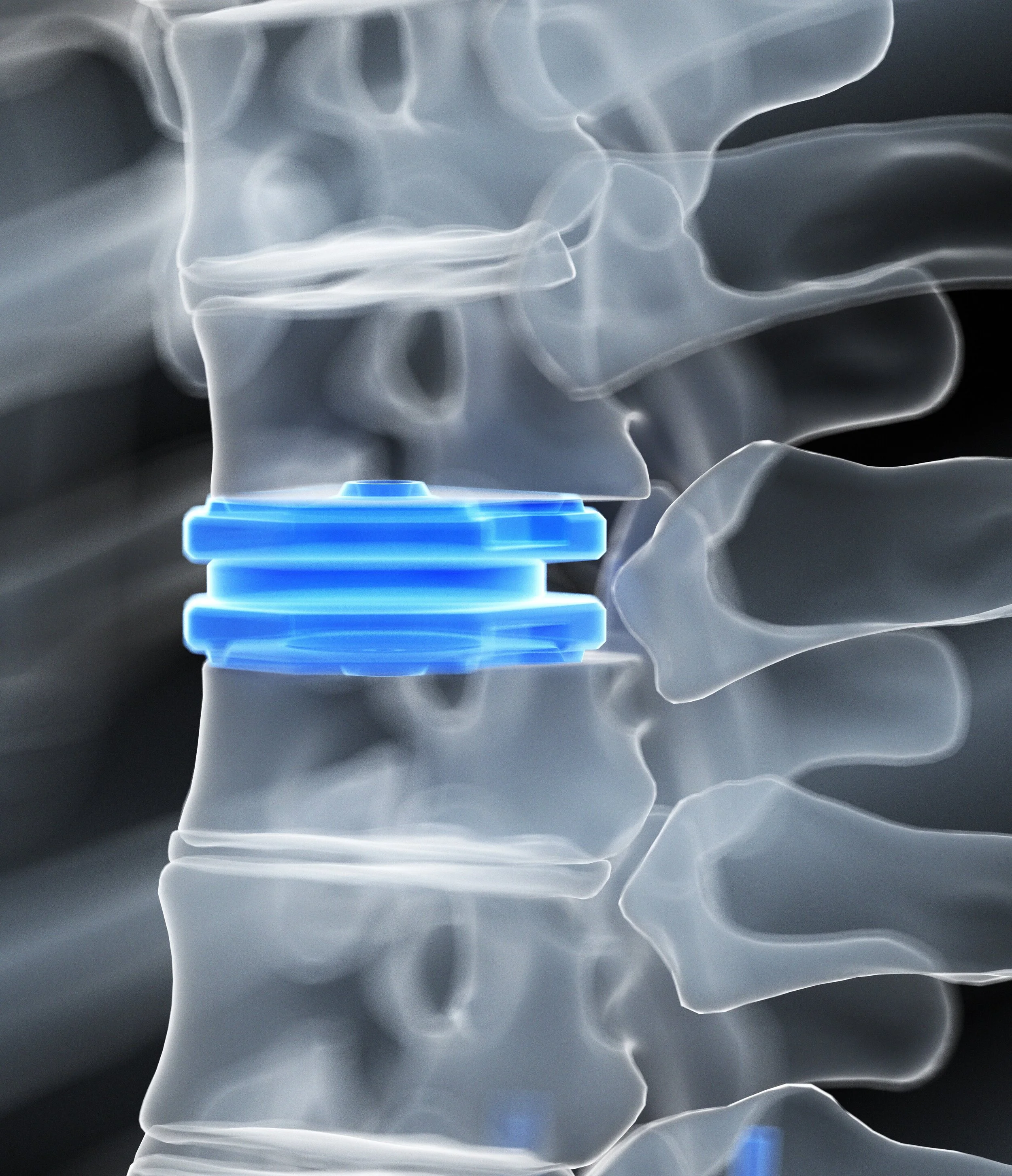 SIB #407- A Surgical Perspective of Sagittal Spine Alignment
