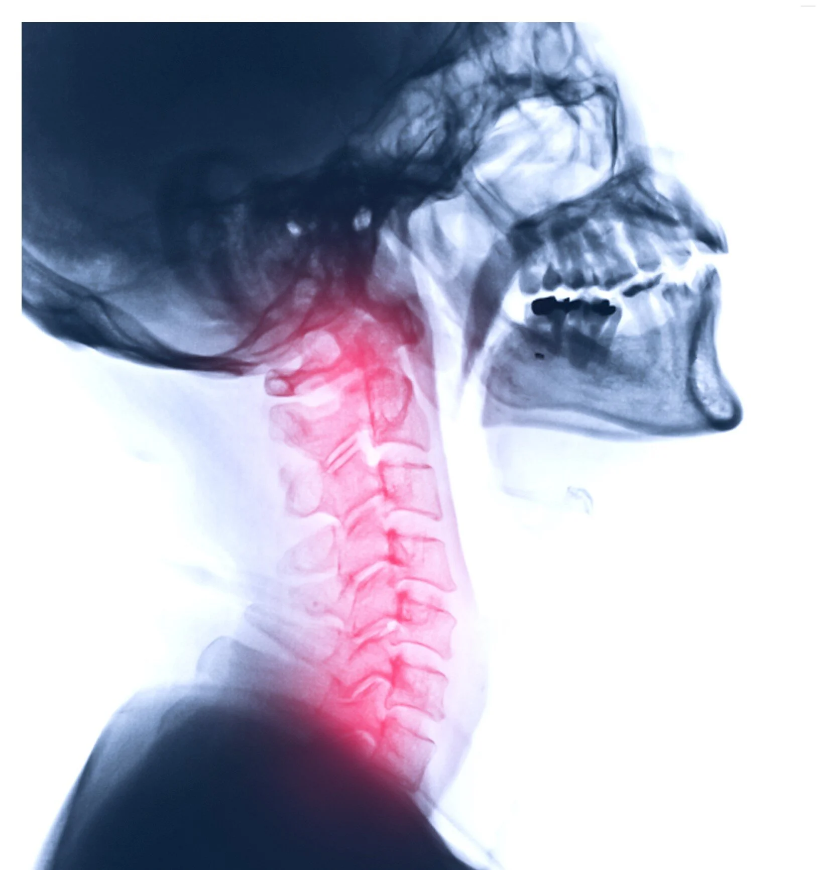 SIB# 428 - Cervical Lordosis and Cervical Disc Herniation