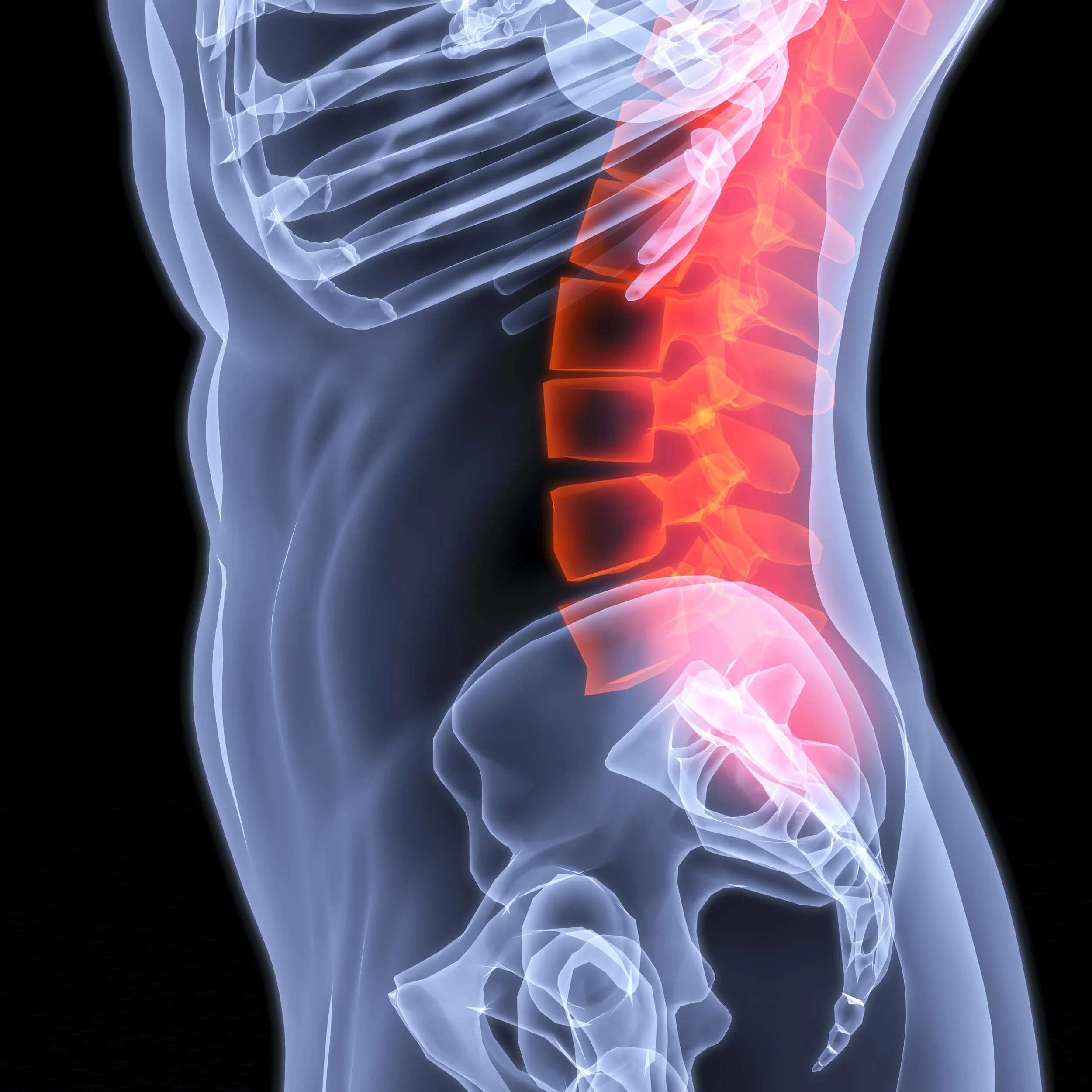 SIB #445- Pain and Lumbar Spine Osteoarthritis