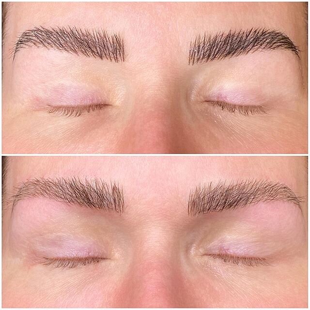 Hair Transplants in The Brows Are a Big Contraindication For Microblading (due to scar tissue &amp; uneven skin texture). However, Being That Melissa is One of My Good Friends, &amp; is Also a Fellow Permanent Makeup Artist Who Understands the Possib