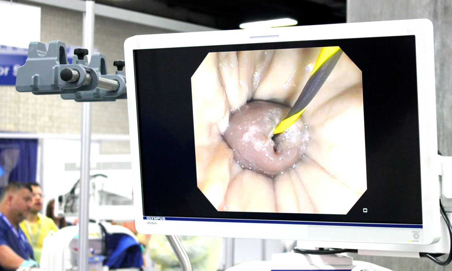 ERCP Neopapilla Cartridge Specimen