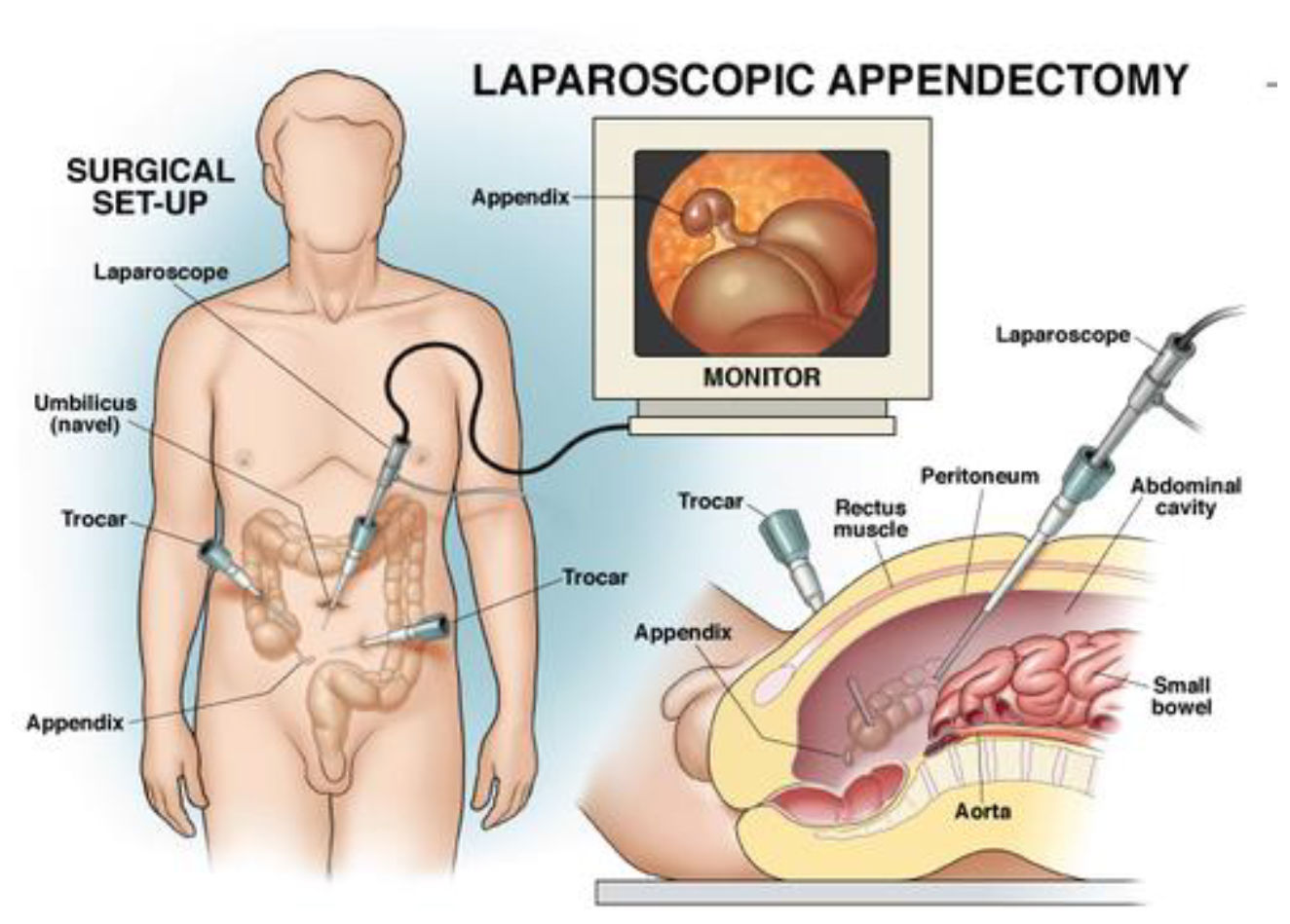 SAGES-PI-Appendix-Removal.png