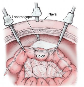 laparscope.png