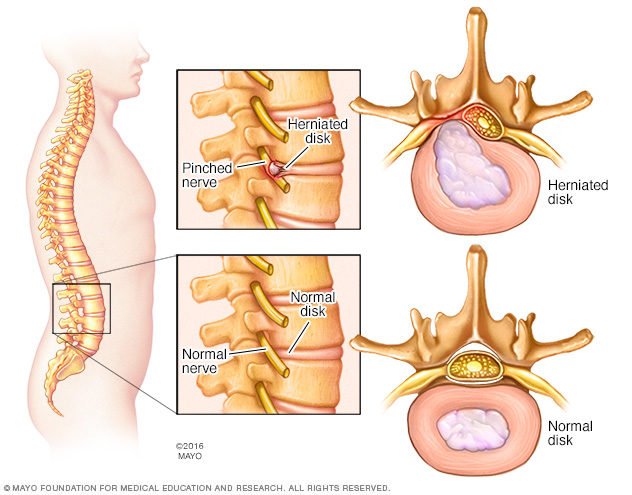mcdc7_herniated_disk-8col.jpg