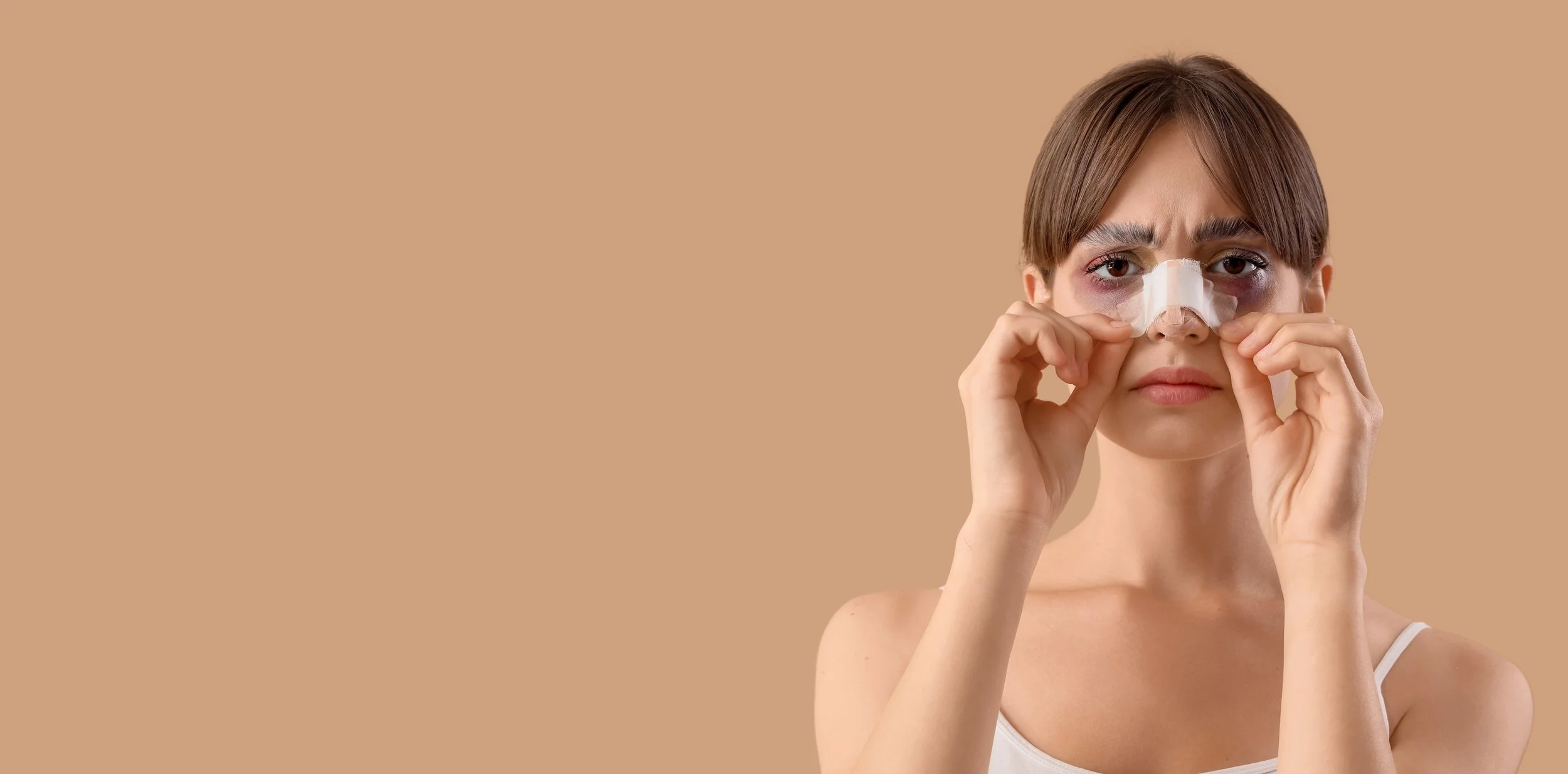 A girl with a rhinoplasty spling, black eyes and healing from rhinoplasty surgery