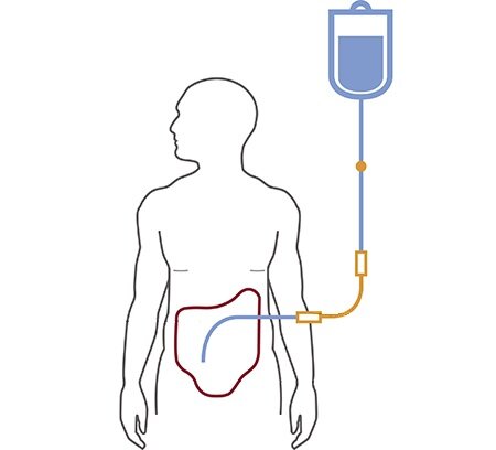 Peritoneal Dialysis Valve