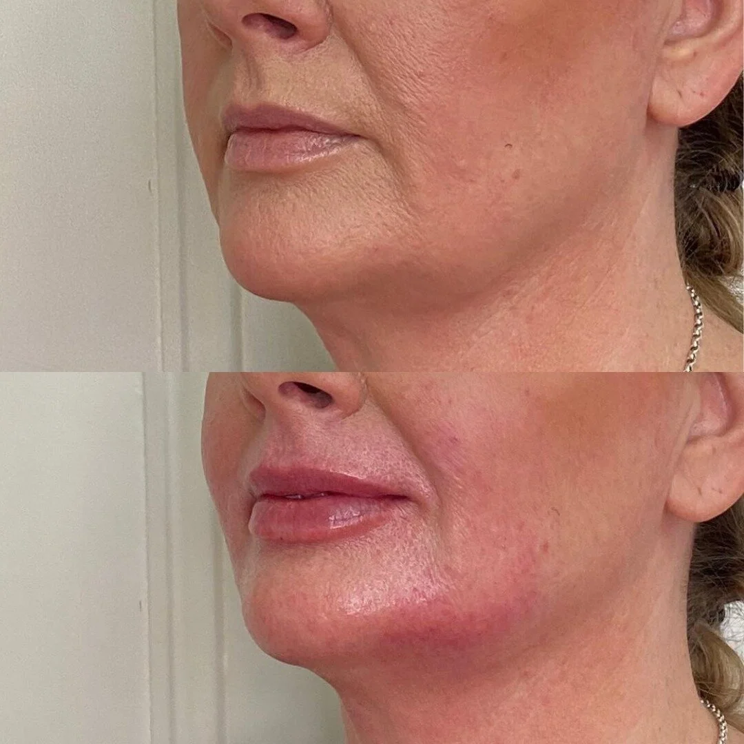 Lower face rejuvenation by @cosmeticnursesally 😍⁠
Sally will be available for Anti-Wrinkle Injections and Dermal Filler from Monday 12th September. Get in touch with our team to book your appointment!