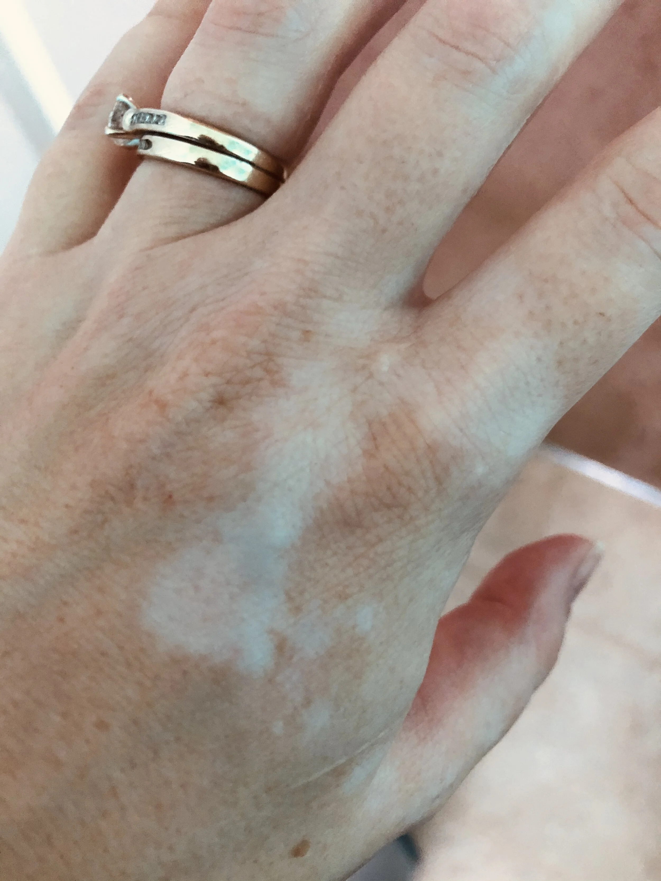 One area of vitiligo on my body which is when you lose pigment. Causes aren’t always known. Sometimes it can be linked to thyroid and blood sugar. My vitiligo spread and got worse during the virus.