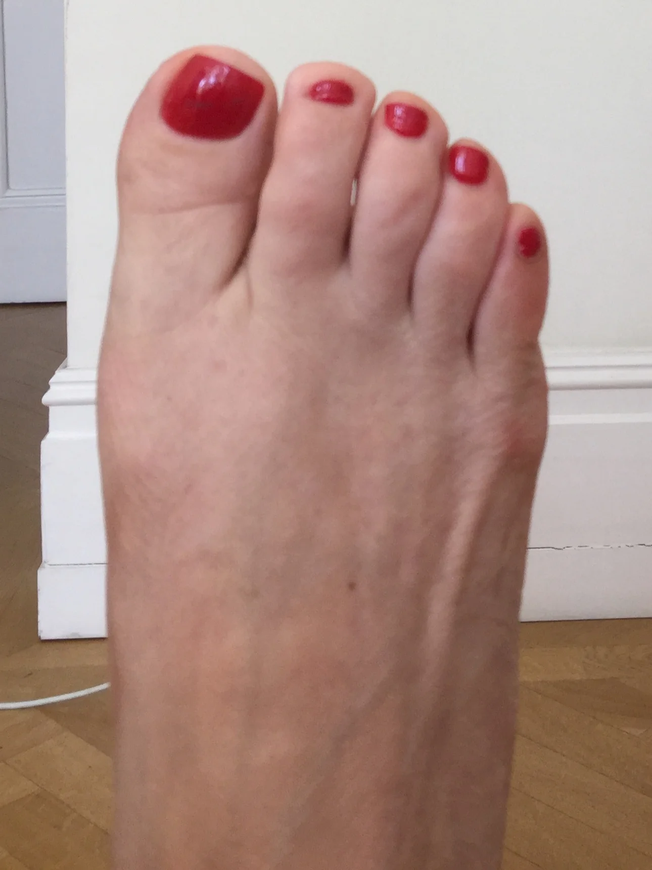Case 5: Four months after MICA (ProStep)