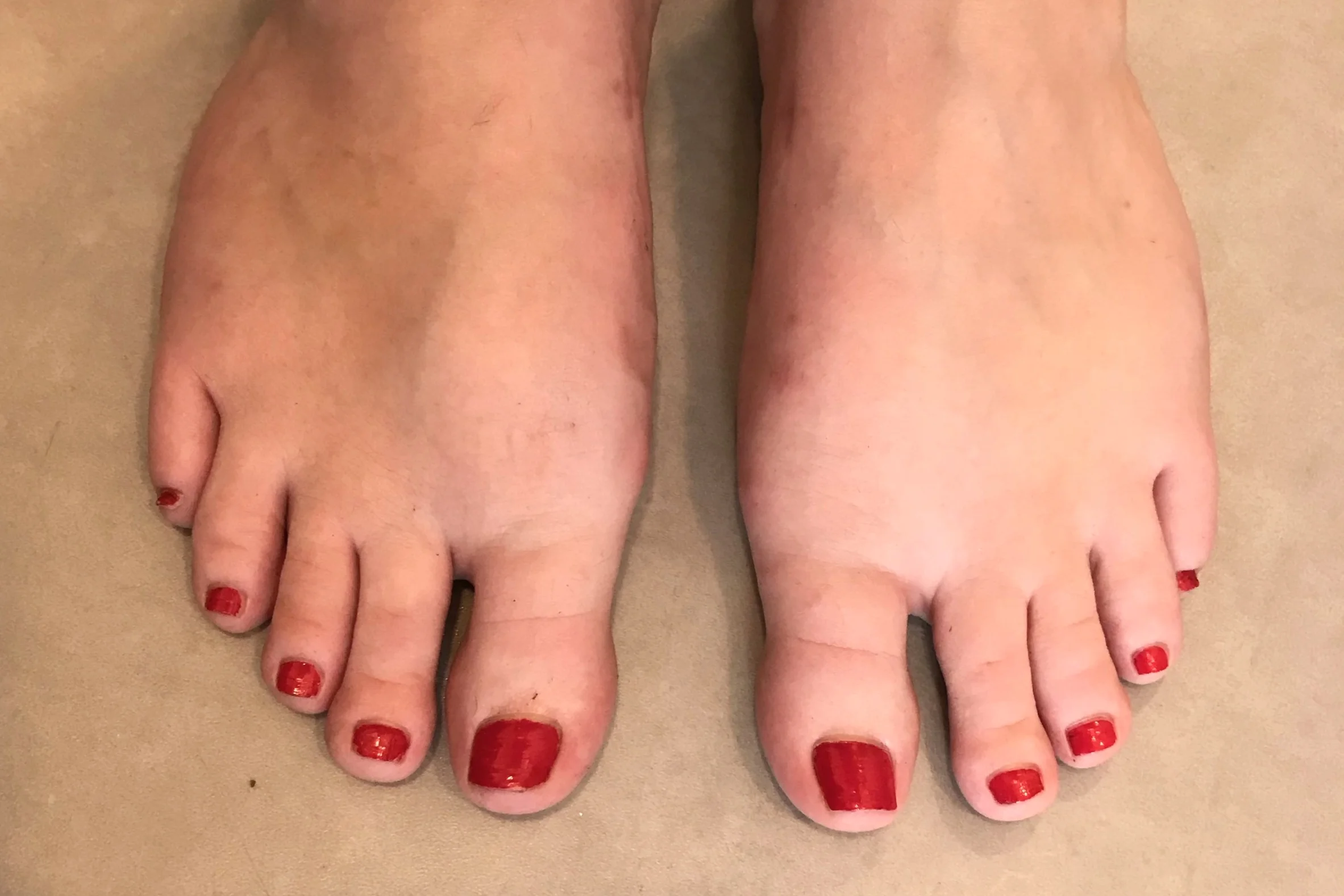 Case 10: Five months after MICA (ProStep) surgery