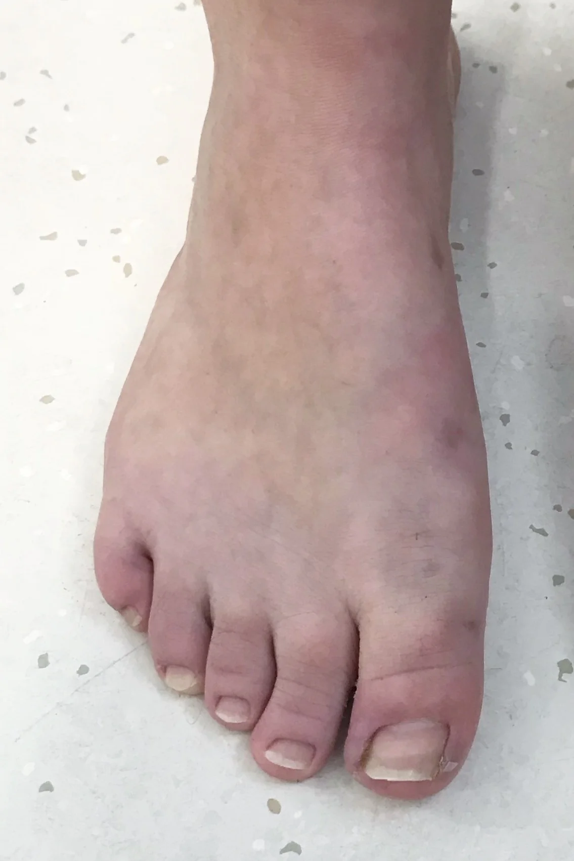 Case 11: Six months after MICA (ProStep) surgery