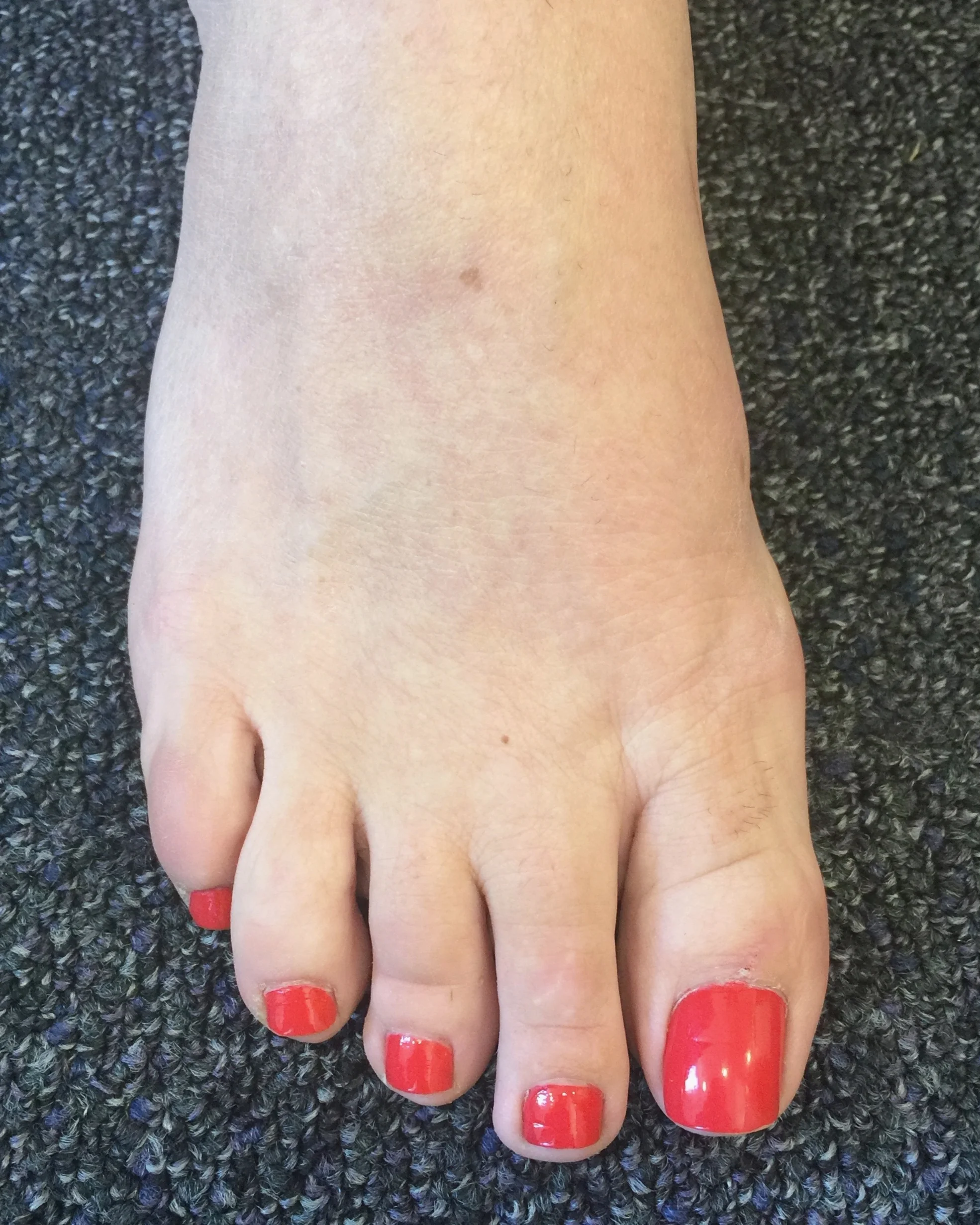 Case 9: After MICA (ProStep) surgery