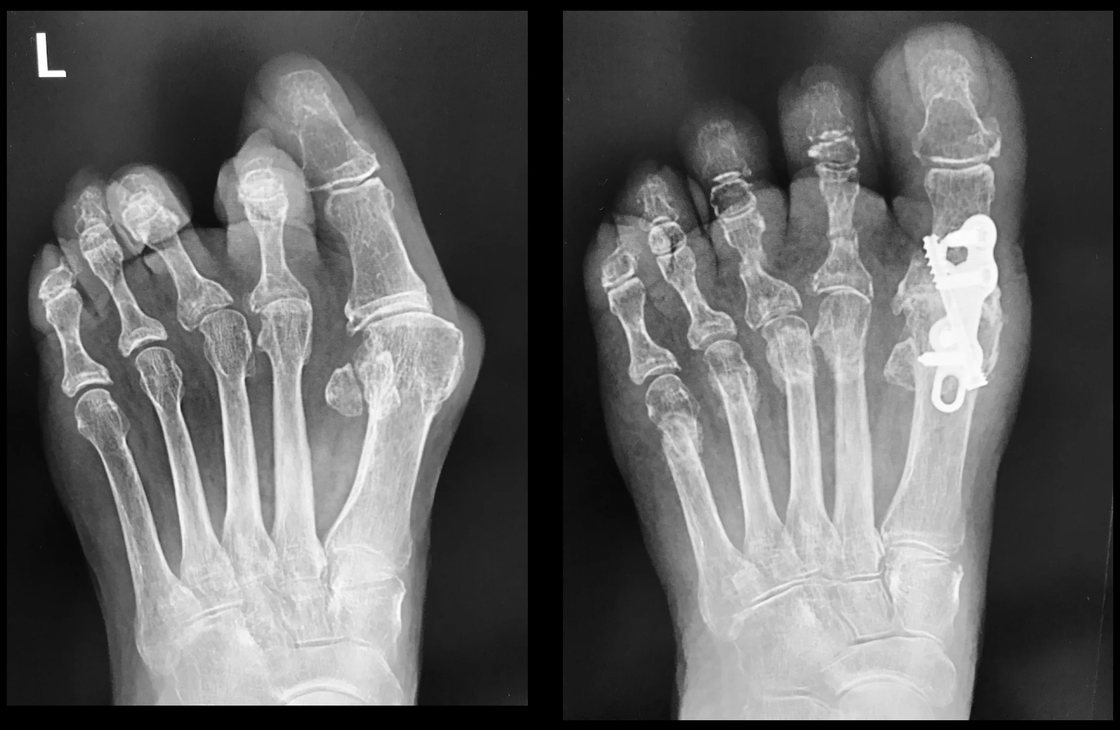 Big Toe Fusion surgery performed by Mr Redfern. The x-ray on the left was before surgery. The patient complained of painful hallux rigidus (arthritis), hallux valgus (bunion) and painful lesser toe deformities (2nd and 3rd toes) with metatarsalgia. The problems were solved with fusion of the big toe joint combined with state-of-the-art minimally invasive surgery to correct the lesser toes. Final x-ray on the right
