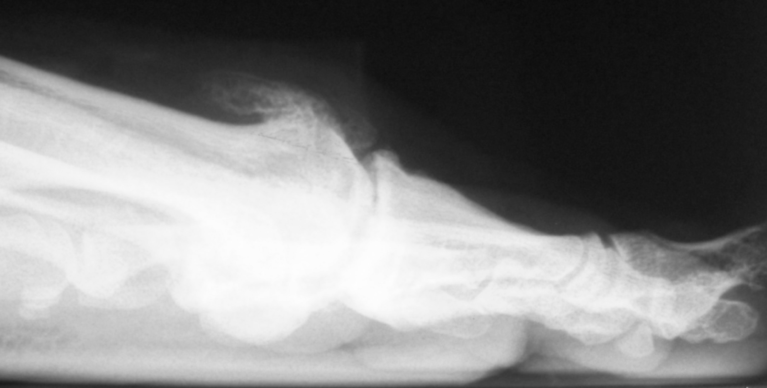 Minimally Invasive Cheilectomy For The Treatment Of Grade I – LEFMAT