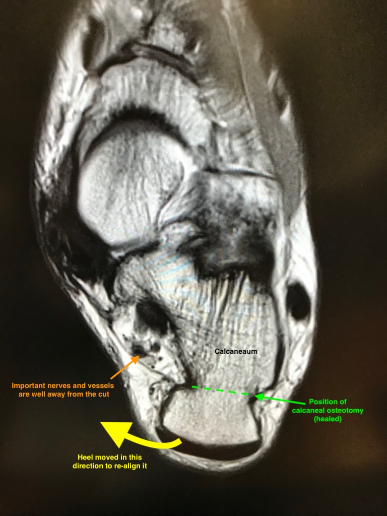 MRI+calc+ost+annotated.jpg