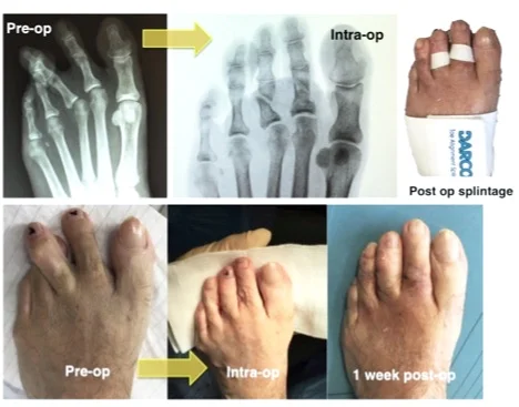 An example of Mr Redfern’s keyhole surgery to treat lesser toe problems .Here is an example of a patient who complained of painful deformed 2nd and 3rd toes which were causing great difficulty with footwear. Mr Redfern undertook minimally invasive surgery to correct the toes without the need for wires or other implants and without fusing the joints rigid. Such deformities are in fact very difficult to adequately correct with traditional open surgery.