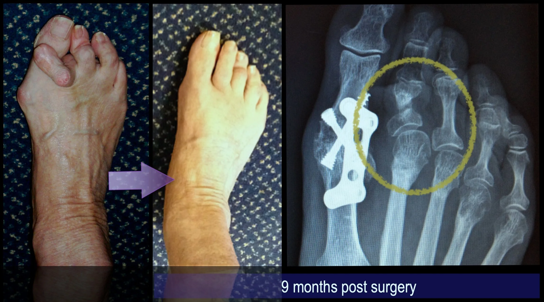 An example of Mr Redfern’s surgery. This severe deformity of the 2nd toe was corrected using minimally invasive surgery in combination with surgery to correct an arthritic bunion.