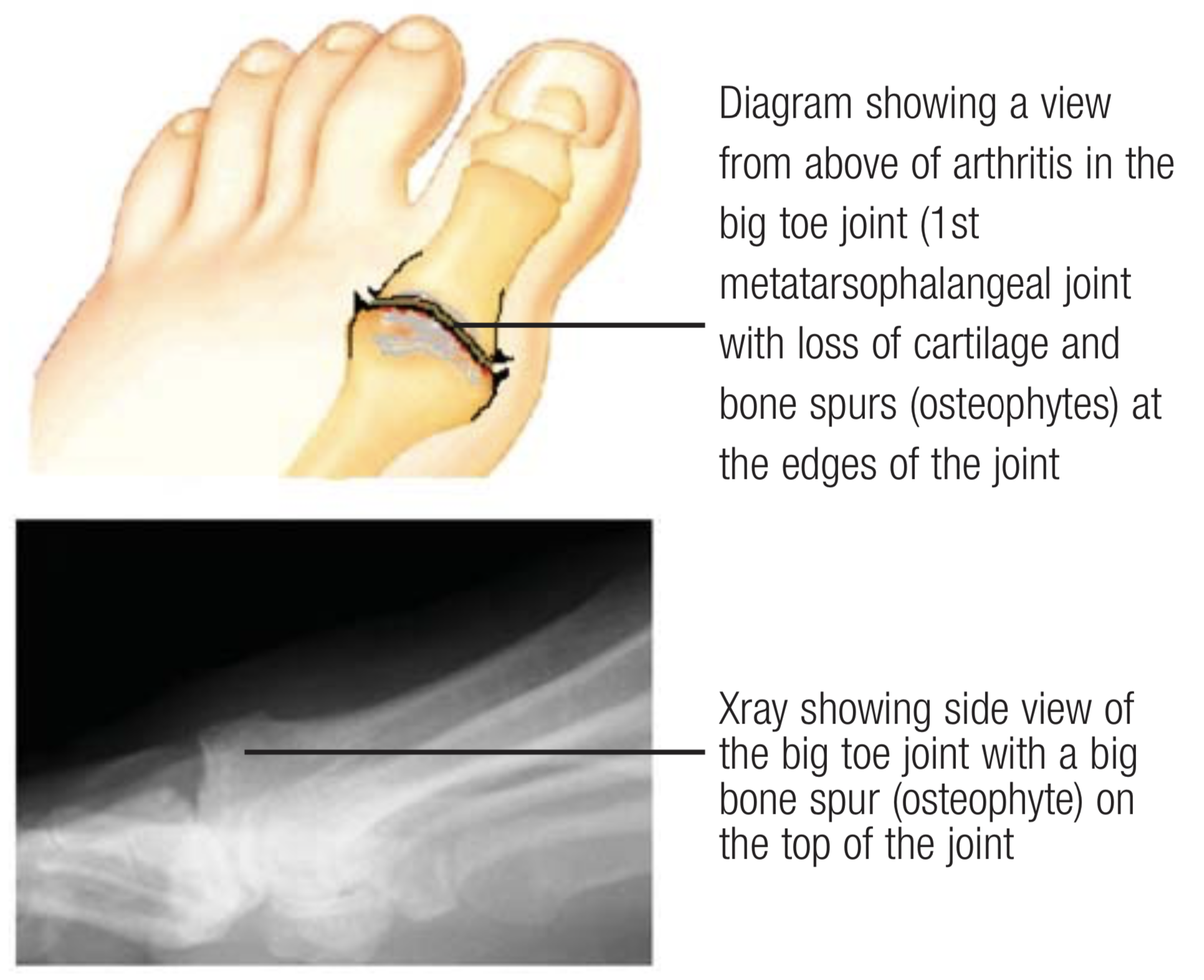 How do I fix my Heel Spur? - San Diego Running & Sports Injury Clinic