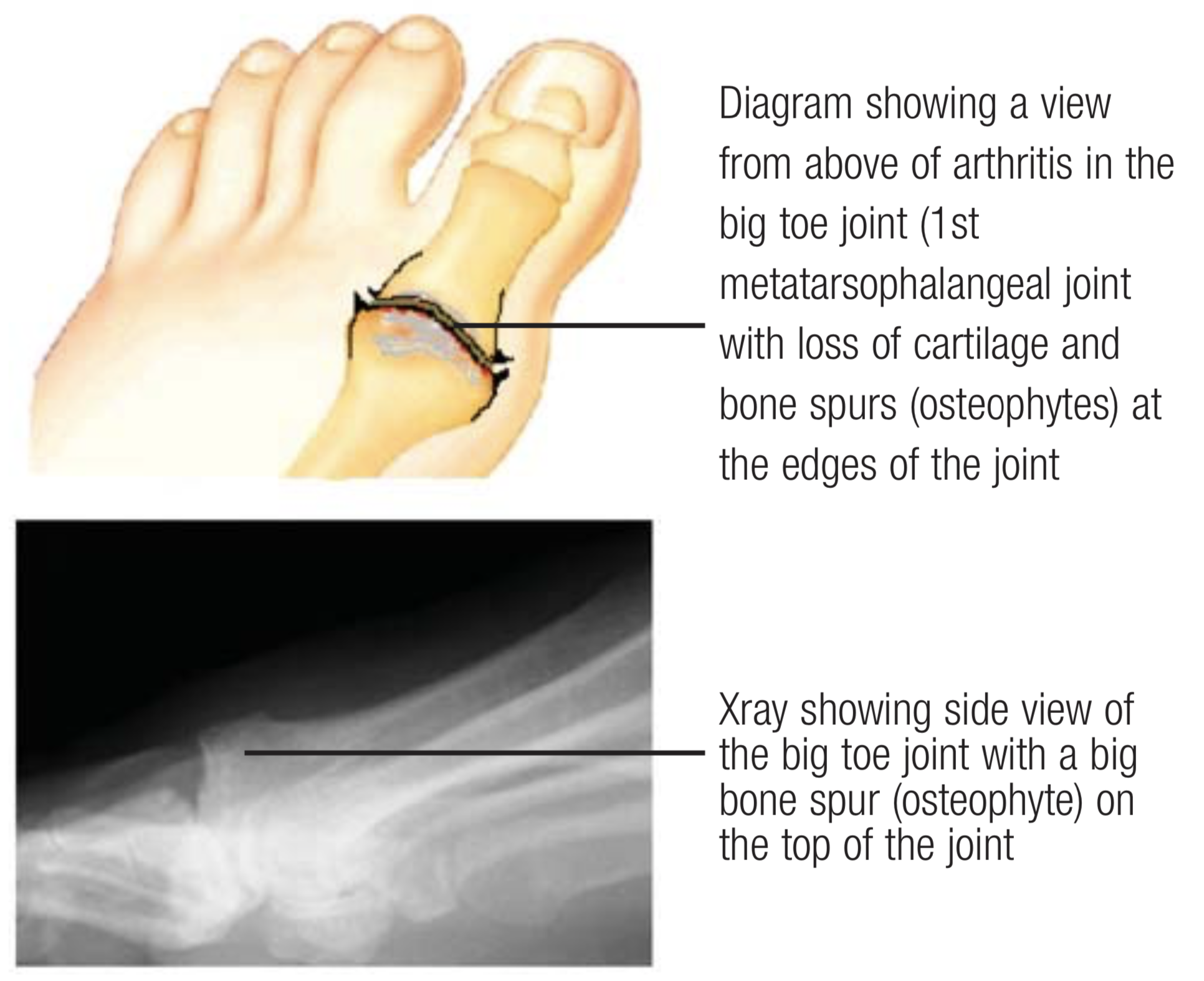 Heel spur removal is a complex surgical procedure wherein painful outgrowth  of the heel bone is treated. Watch Dr Chandan Narang, Ankle… | Instagram