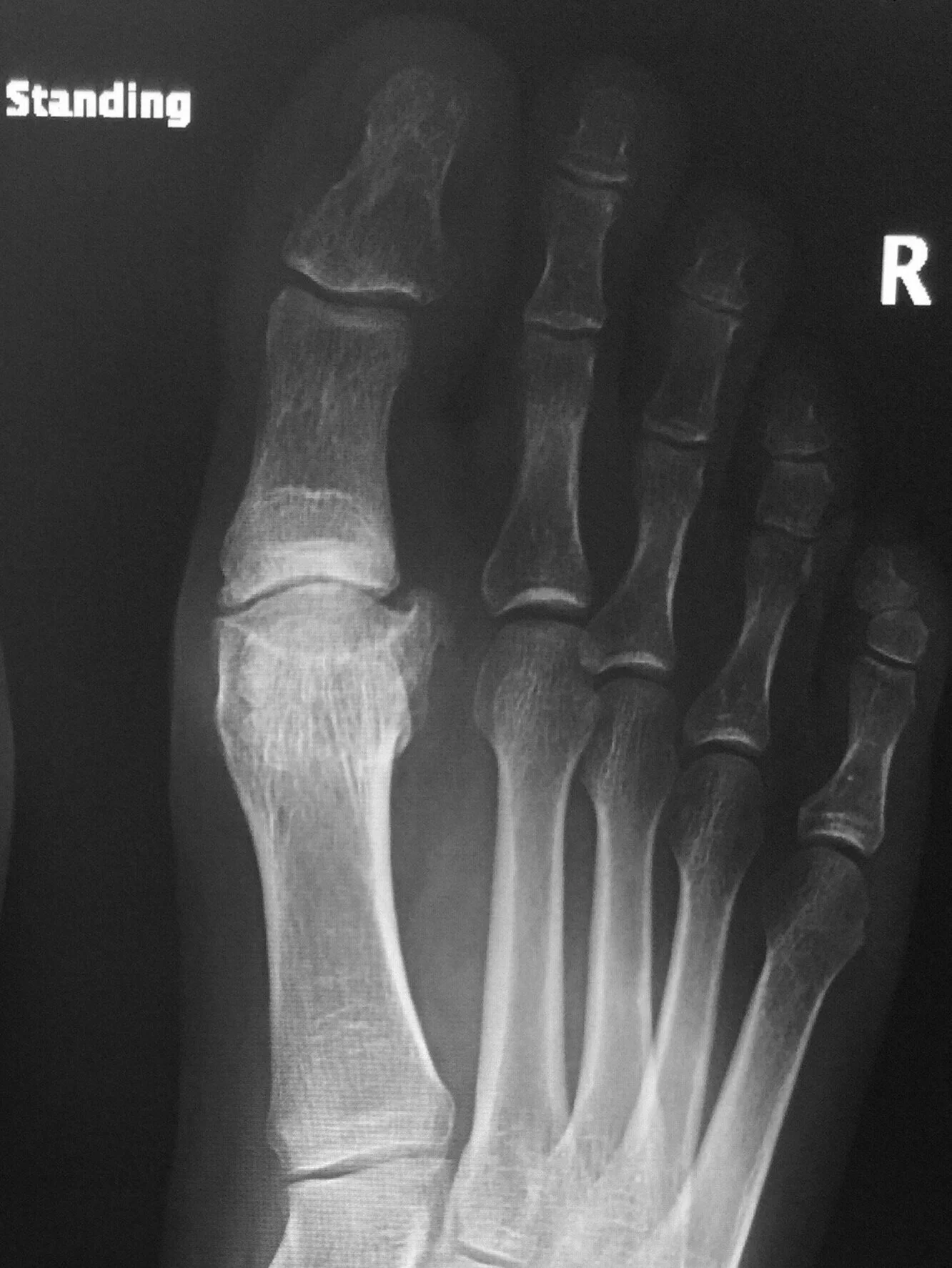 Minimally invasive Hallux Rigidus Osteotomy — David Redfern Surgery