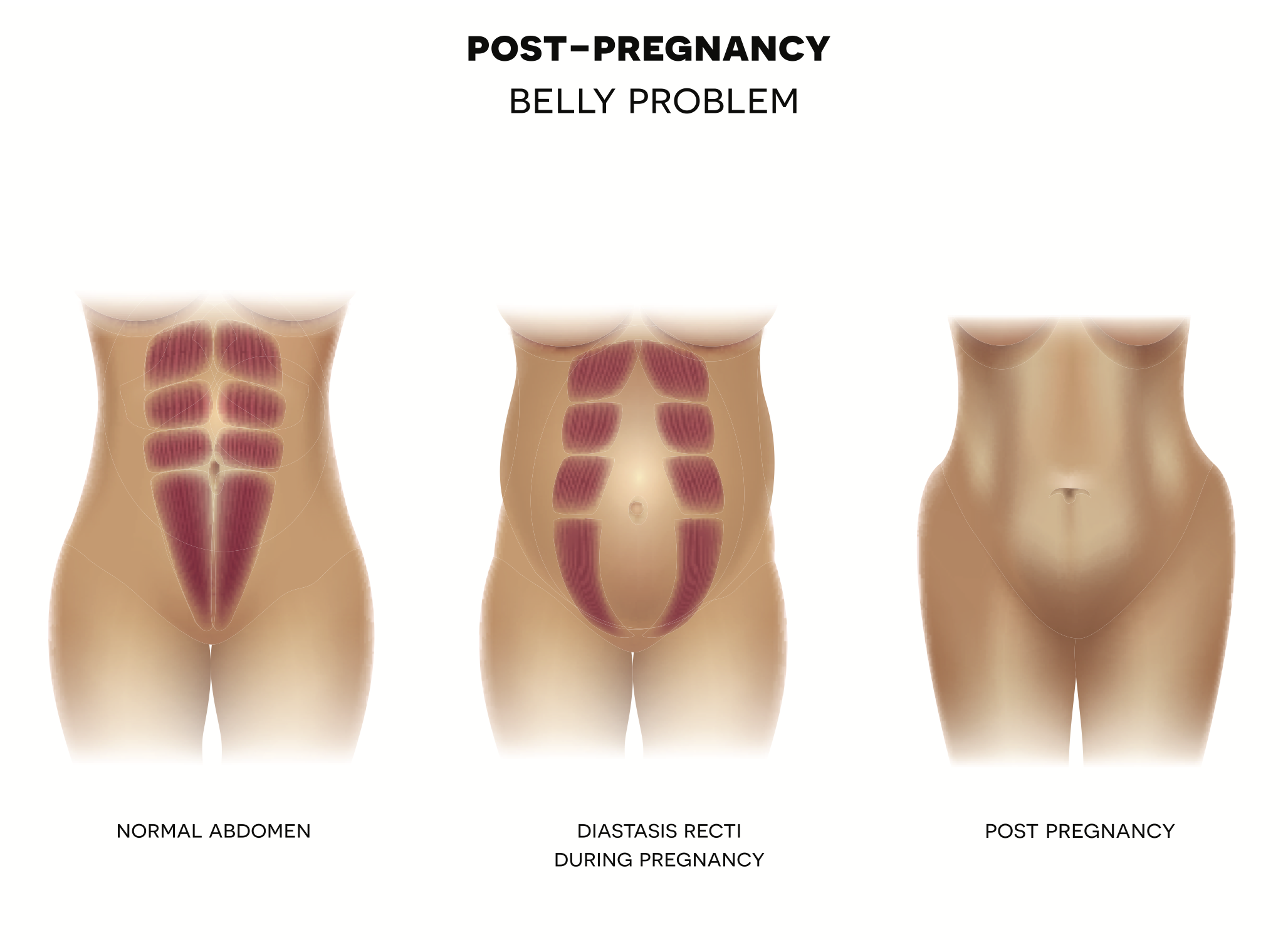 Diastasis Recti (Separated Abdominal Muscles) - Diagnosis, Causes ...