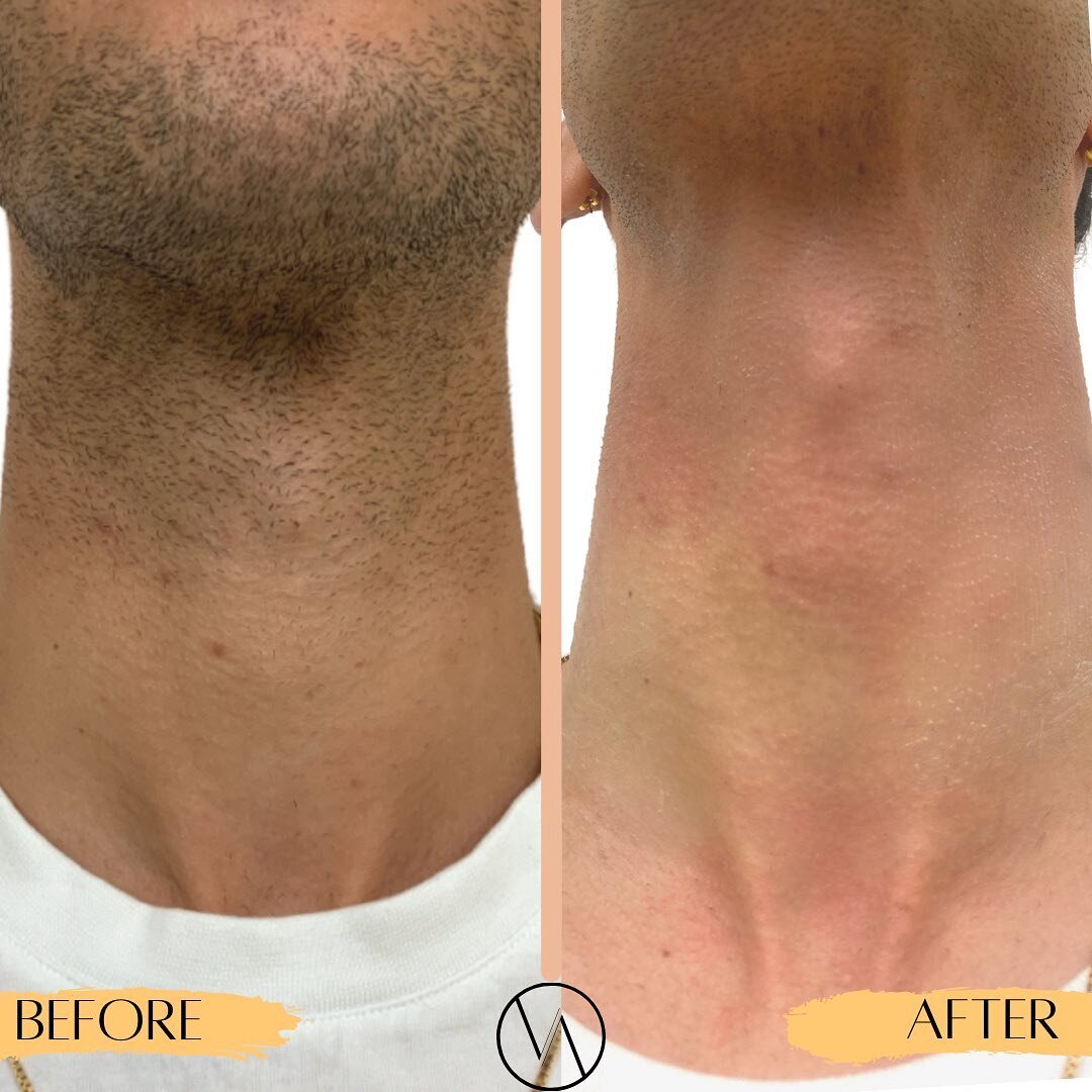 The results after an 8th session of LHR! 🤩
👉🏼 Reduction in hair &amp; follicle sizes become smaller 
👉🏼 Improvement in complexion, texture &amp; skin tone 
👉🏼 You can benefit from LHR as it&rsquo;s a great way to prevent ingrown hairs from occ