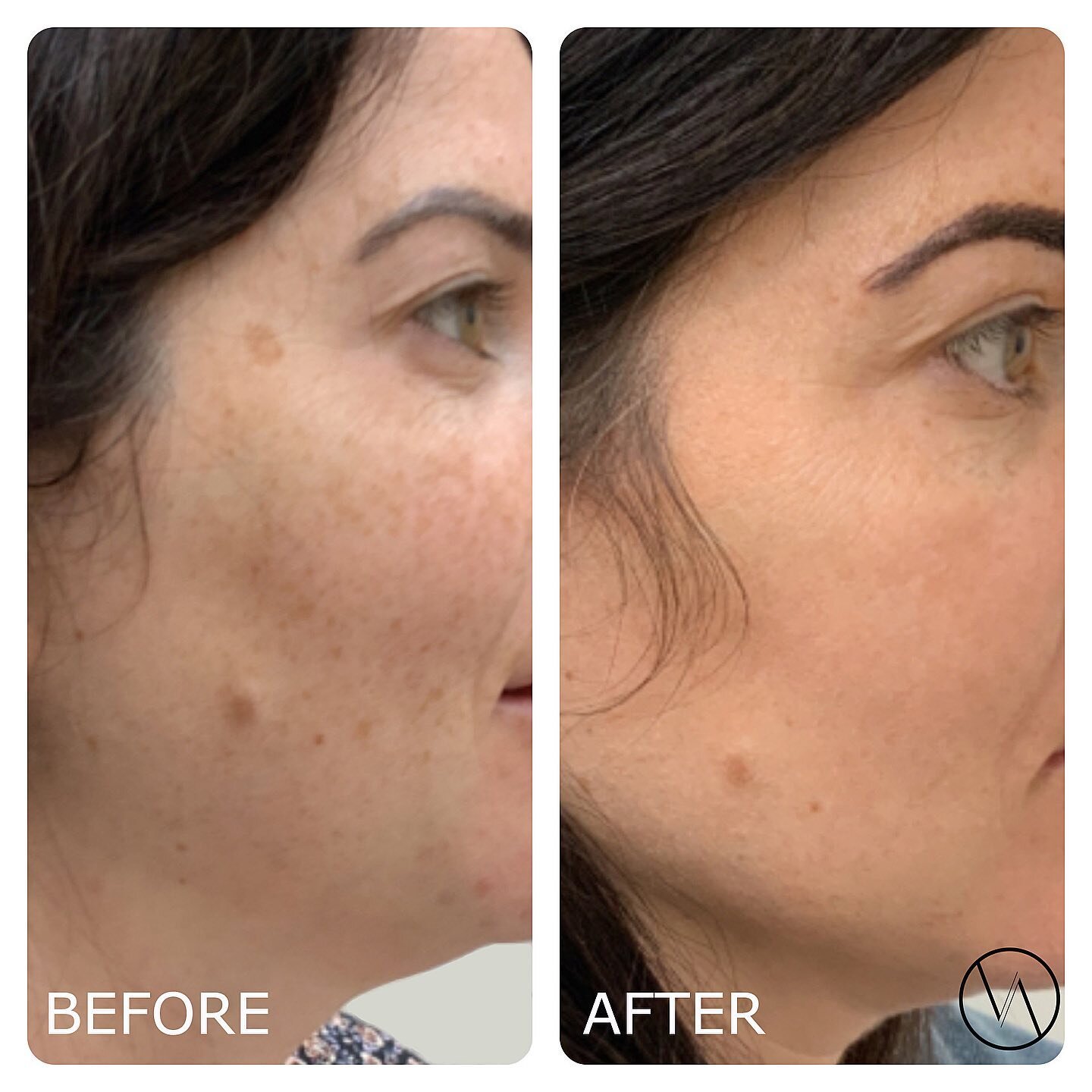 This is the perfect time to prep your skin for summer! 👏🏻 Our IPL Treatment leaves your skin looking vibrant &amp; radiant! ☀️ 

👉🏼 Patients notice significant improvement in the complexion and clarity of their skin, making it an incredible skin 