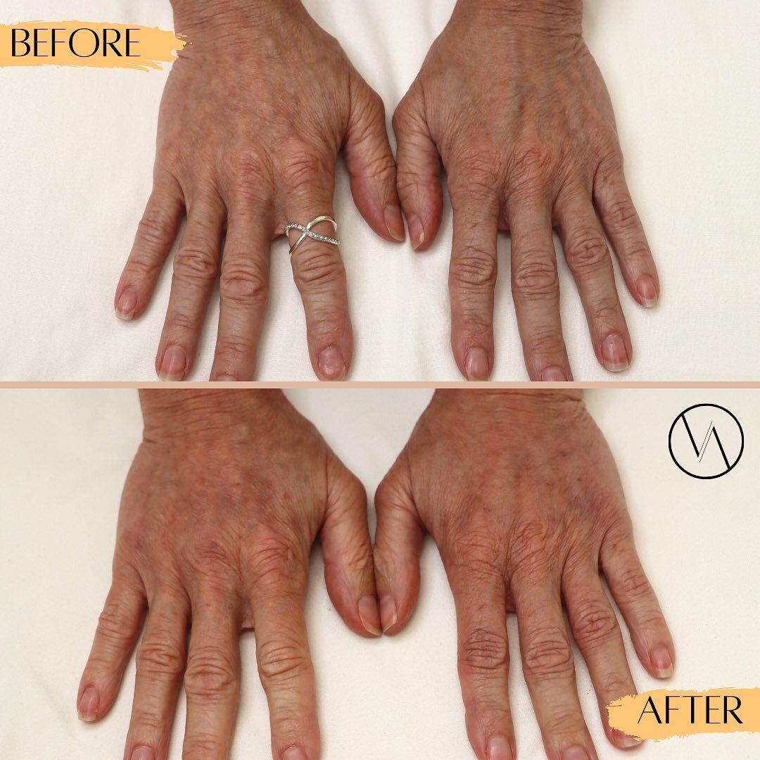 Did you know @vivantaesthetics offers treatments for various areas of the body? 
-
👉🏼 Here we used 1 syringe of Voluma on each hand for our lovely patient.
This helps hydrate &amp; restore volume for a more youthful appearance! ✔️🤩
.
.
.
.
👉🏼 Bo