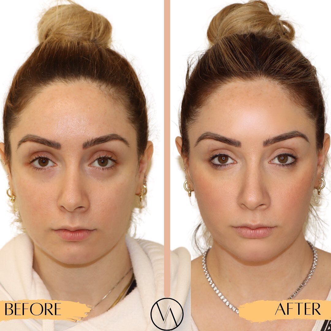 Natural-looking, subtly rejuvenated cheeks! 👏🏻

👉🏼 Restylane Contour is the only cheek filler with XpresHAn Technology&trade; that restores your natural contour! 
👉🏼 Swipe for these subtle, yet lifted before &amp; afters! 
.
.
.
.
✨ Call us for