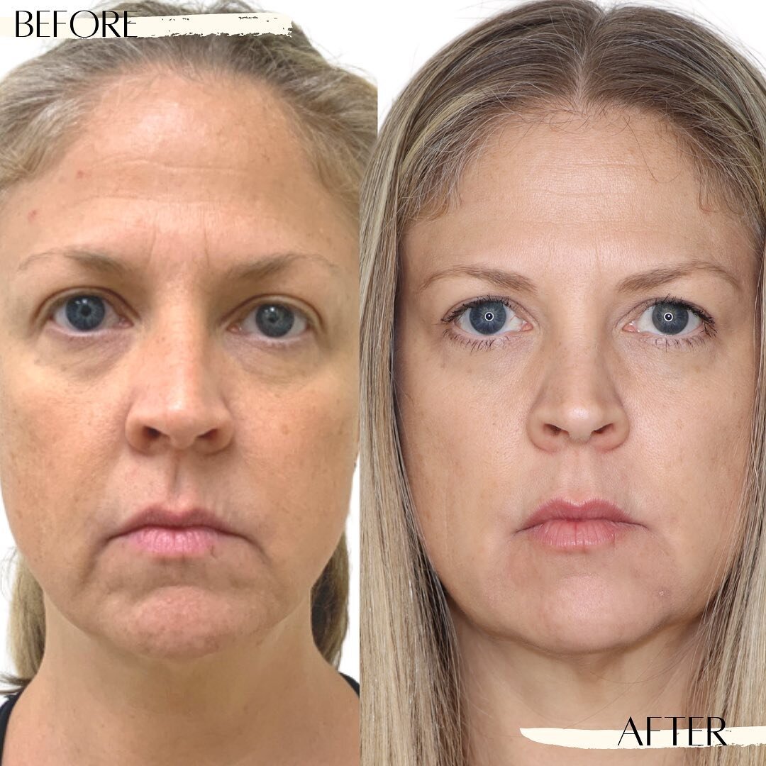 👉🏼 What Can Botox Treat?
Remove visible signs of aging, enhancing your natural beauty! ☺️

👉🏼 Swipe for these amazing before &amp; afters! 
.
.
.
.
✨ Book your appointment now! 
⌨️ www.vivantaesthetics.com
.
.
.
.
 #naturalbeauty #beauty #skincar