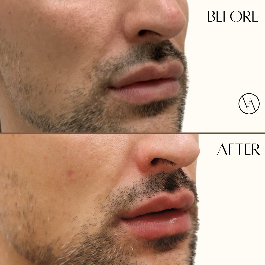 We&rsquo;re loving these subtle, yet luscious, plump lips!💋
.
.
.
✨ Call us for you next appointment!
☎️ (323) 431 8981
⌨️ www.vivantaesthetics.com
.
.
.
.
 #naturalbeauty #beauty #skincare #vivantaesthetics #medicalspa #melrose #lift #lips #plump