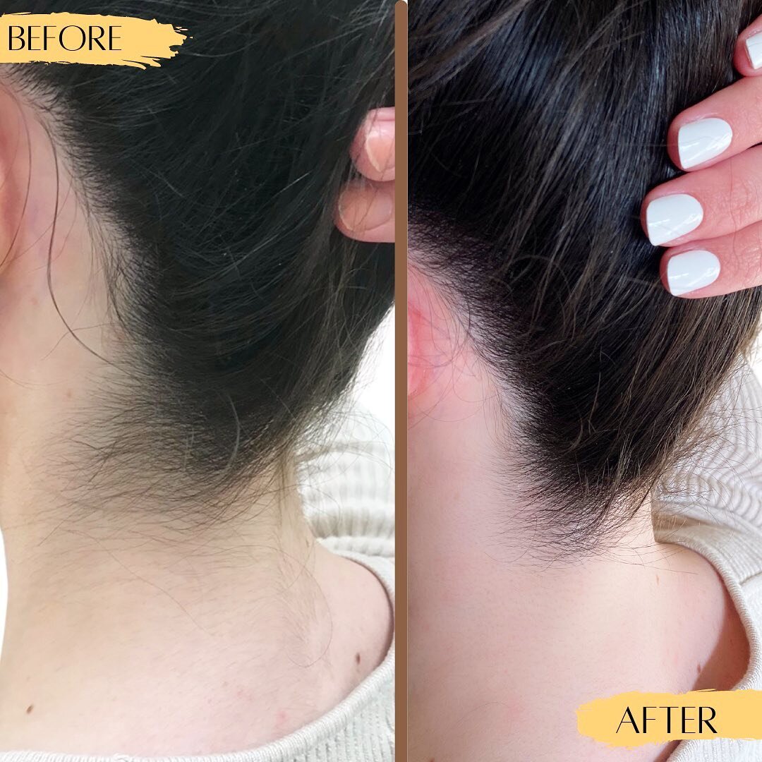 Did you know you can use Laser Hair Removal to achieve a more clean, feminine, fresh look? 👀

👉🏼 Eliminate neck hair &amp; the need to shave hard to reach places in a few sessions! 
Something you won&rsquo;t regret! 🤍 It&rsquo;s all in the detail