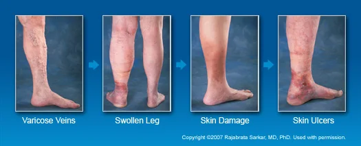 venous_symptoms.jpg