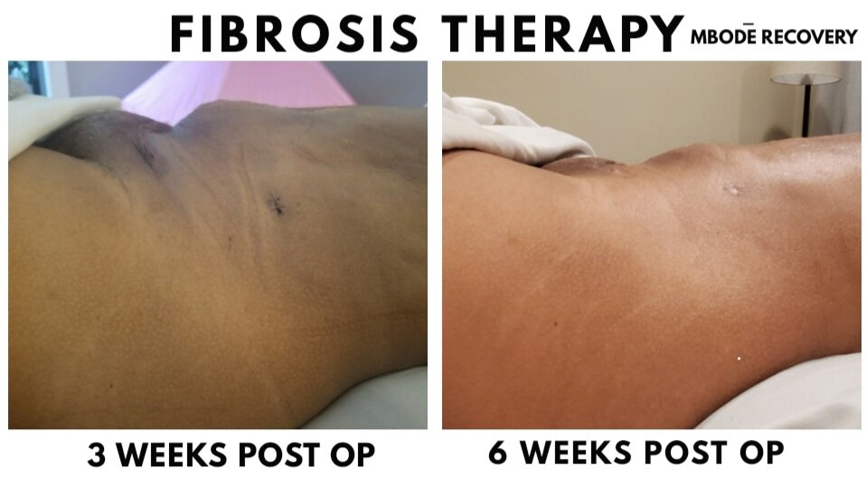 fibrosis therapy client before and after.jpg