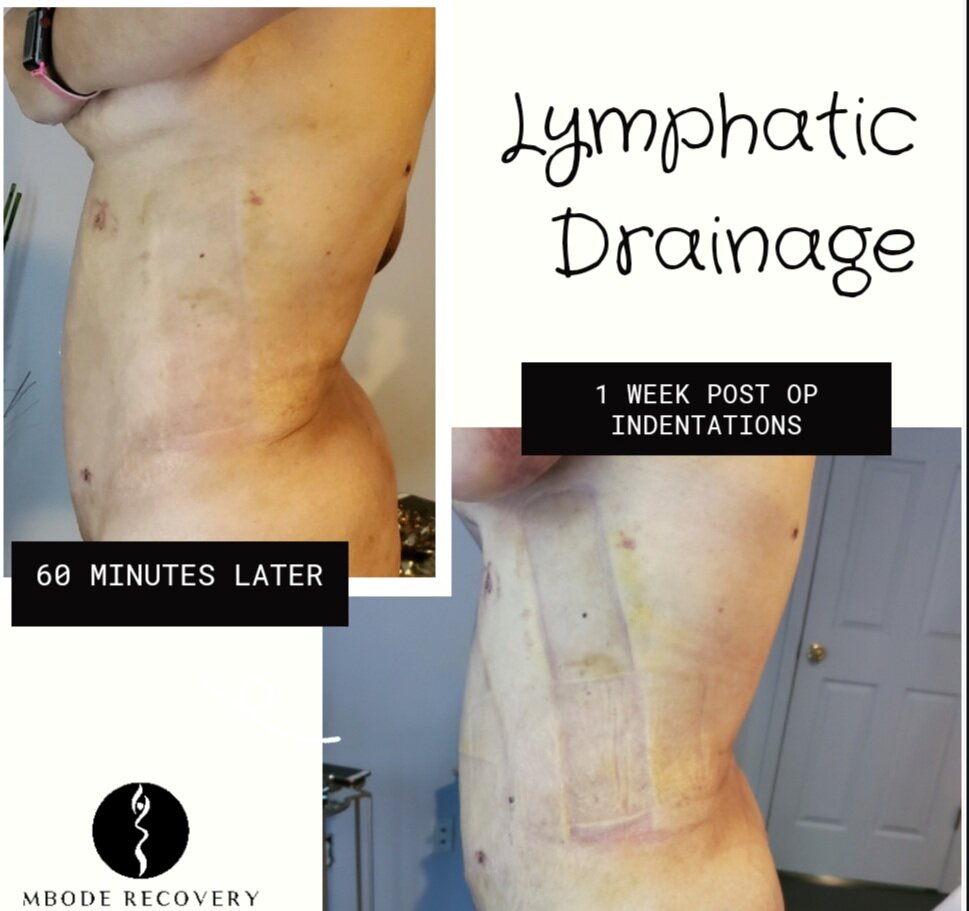 lymphatic drainage results.jpg