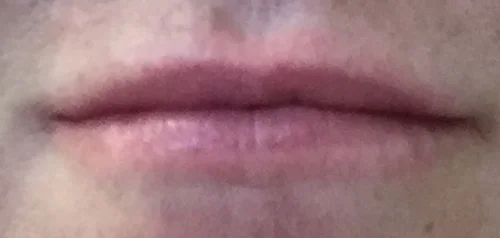 Lip before.jpg