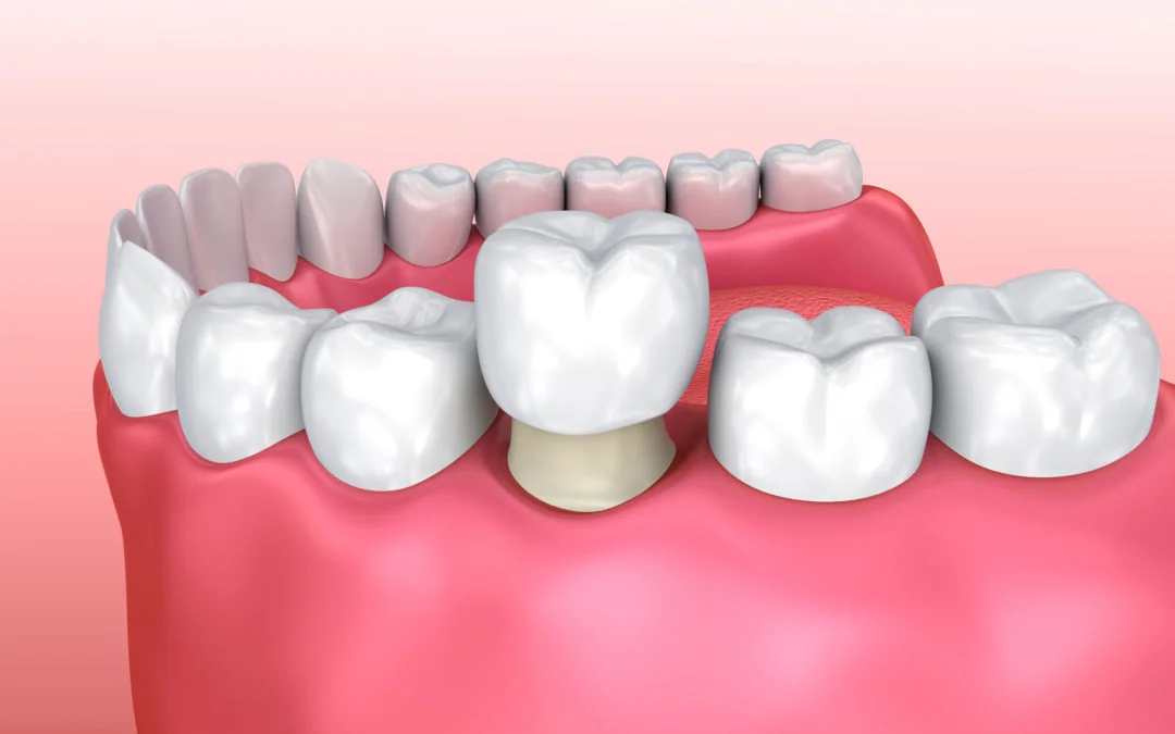 dental-crowns-1080x675.jpg
