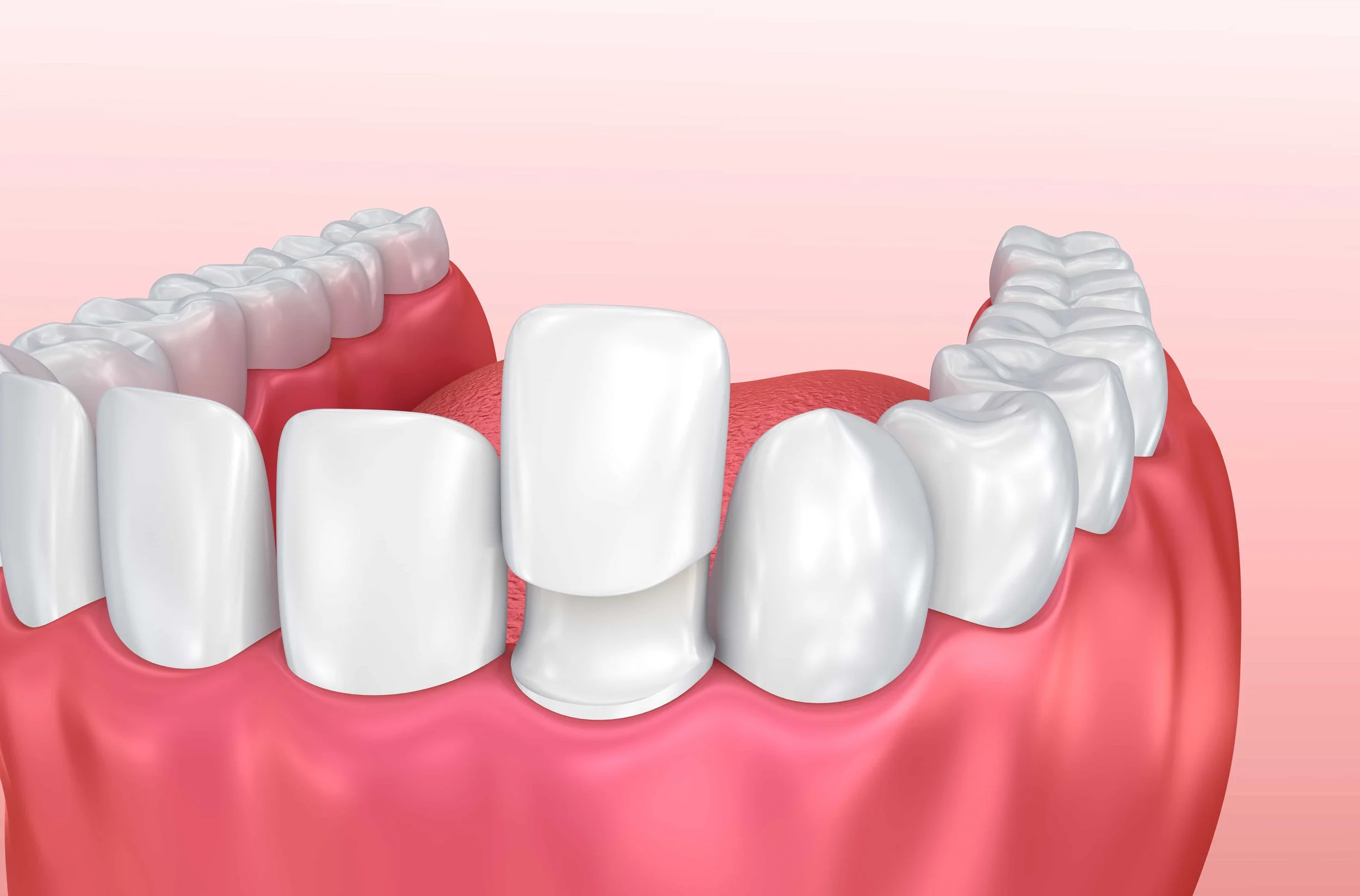 3-Benefits-of-Custom-Porcelain-Veneers.jpeg