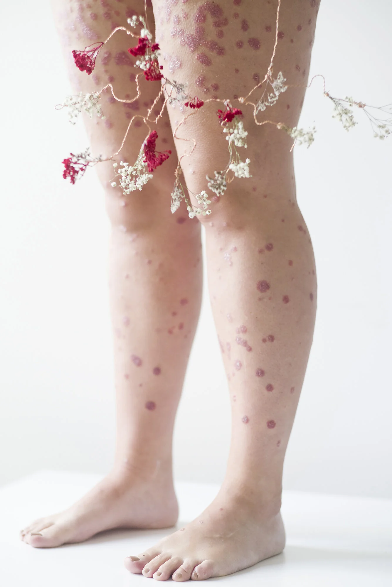 Psoriasis
