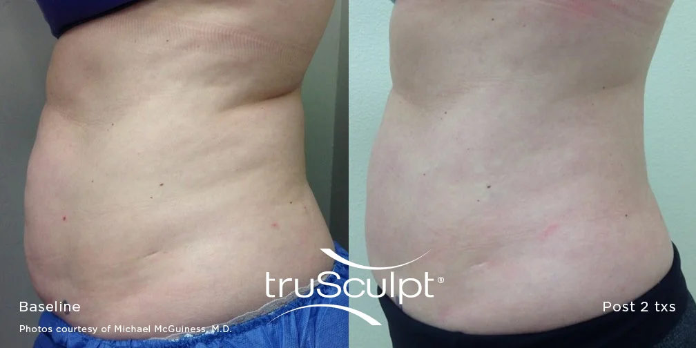 truSculpt_Body_14.jpg