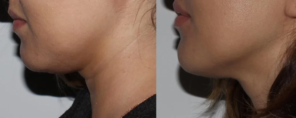 truSculpt-chin-at-Central-Park-Beauty-1024x514.jpg