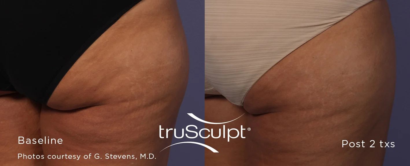 truSculpt_Body_5.jpg