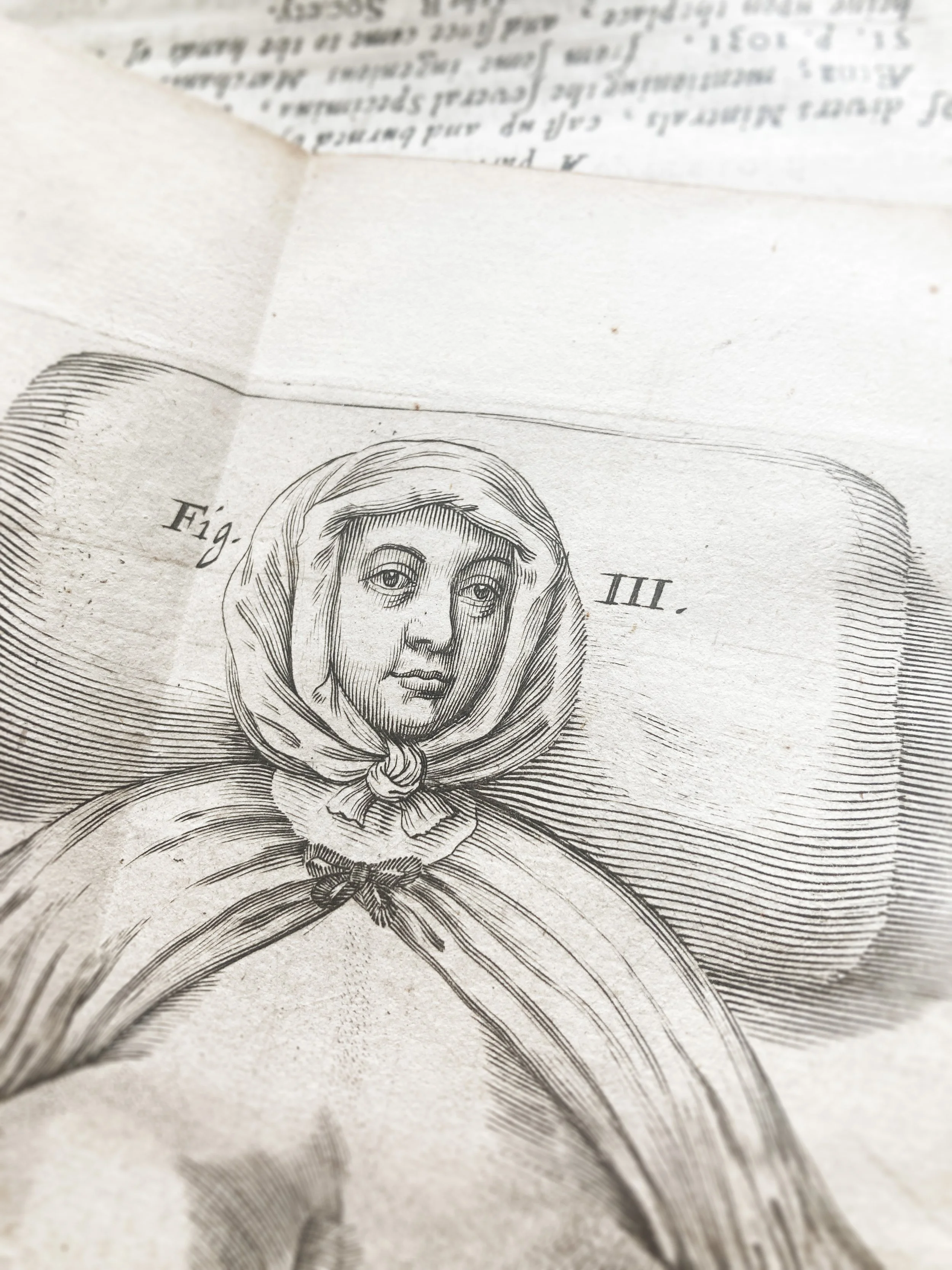 The first recorded and illustrated case of gigantomastia/breast hypertrophy, in the Phil Trans 1669