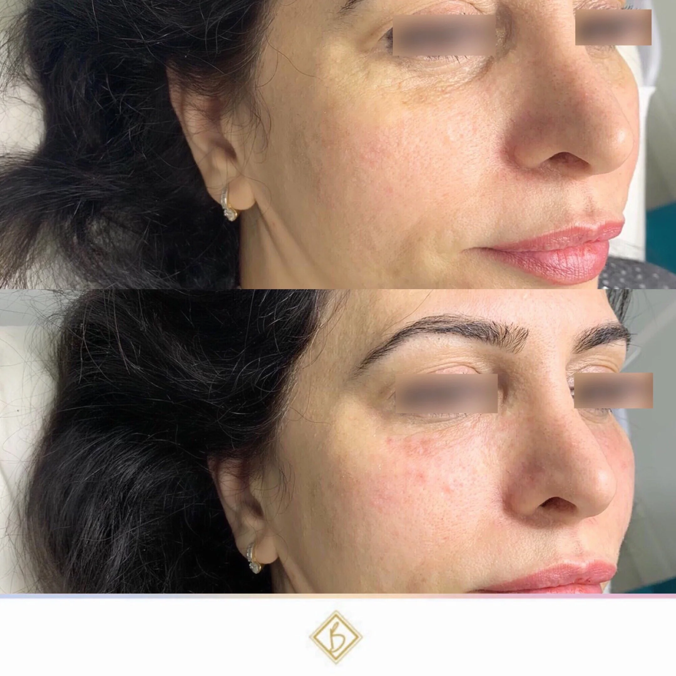 tear trough filler under eye wrinkles