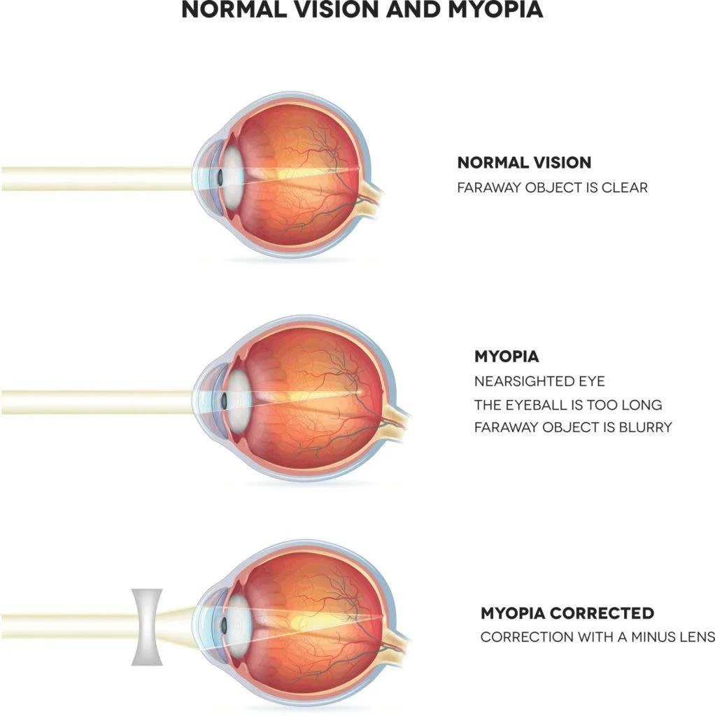 Myopia Control — 20/20 Eye Wellness Optometry